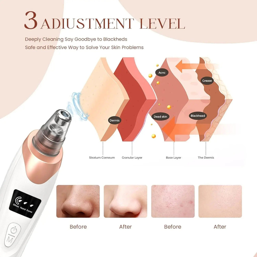 Mosrugs | Blackhead Remover Vacuum Pore Cleaner | Adjustable Suction, Multi-Functional Tool for Deep Cleansing & Acne Treatment at Home